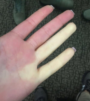 You might be a Raynaud’s sufferer if…