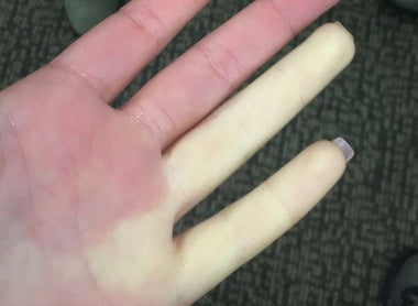 You might be a Raynaud’s sufferer if…