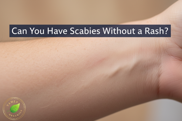 Can You Have Scabies Without a Rash?