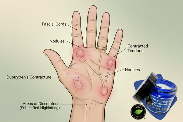 Does Dupuytren's Contracture Cause Pain?