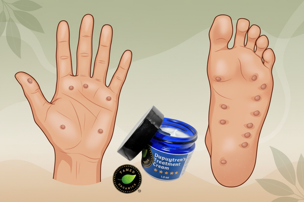 Can Dupuytren's Contracture Affect Your Feet?