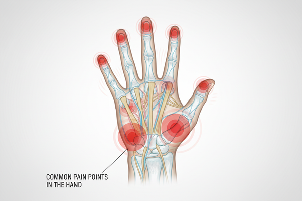 Why Is My Finger Swollen Near the Palm?