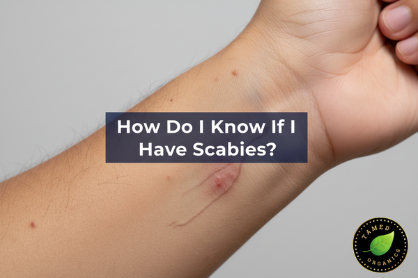 How Do I Know If I Have Scabies? Key Signs to Watch For